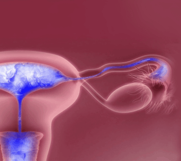 Endometriosis 5 1 360x320