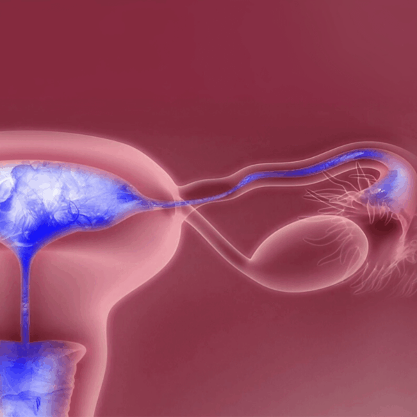 Endometriosis 5 1 600x600