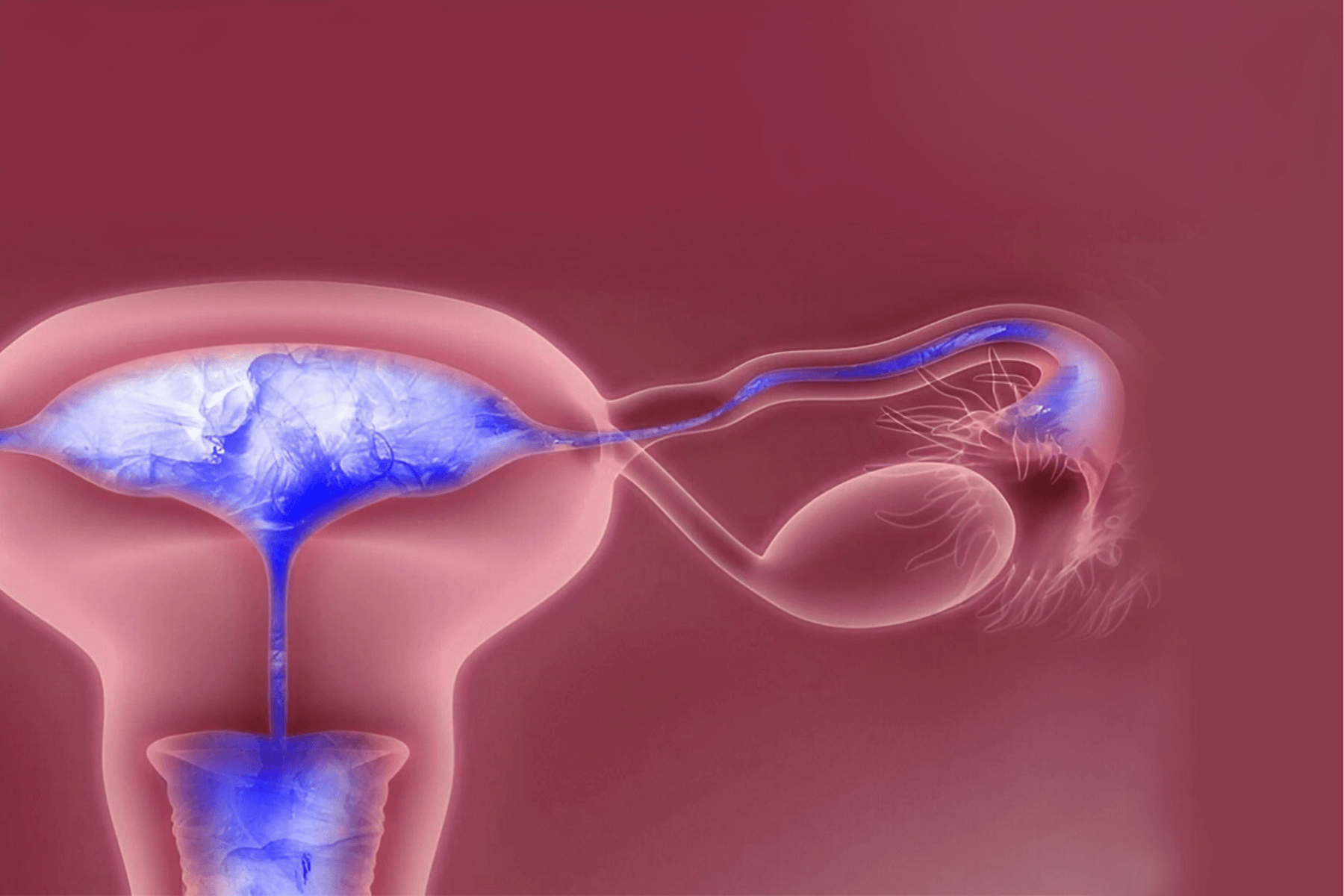 Endometriosis 5 1