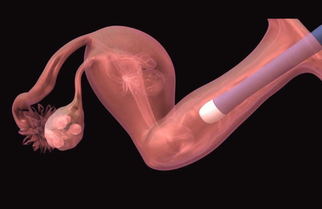 IVF 2 1